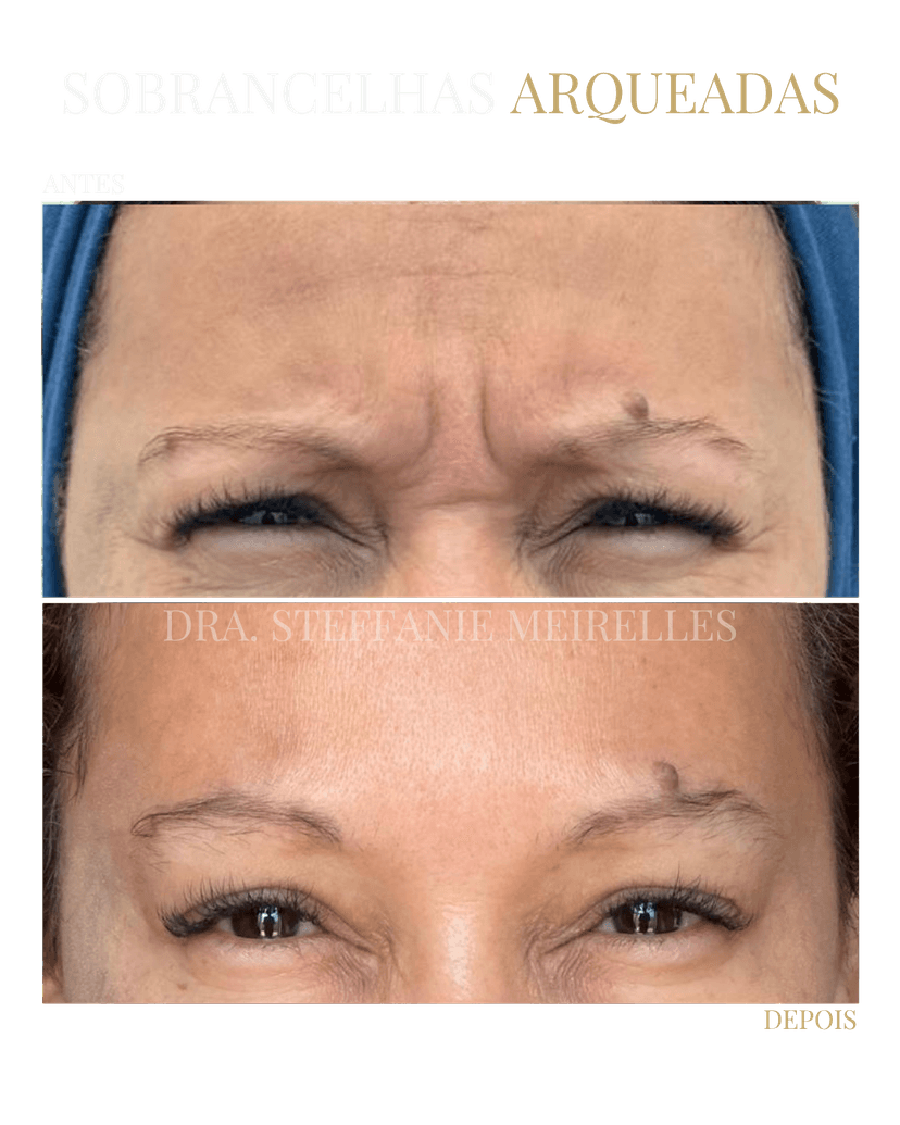 Antes e depois aplicação de Botox rosto