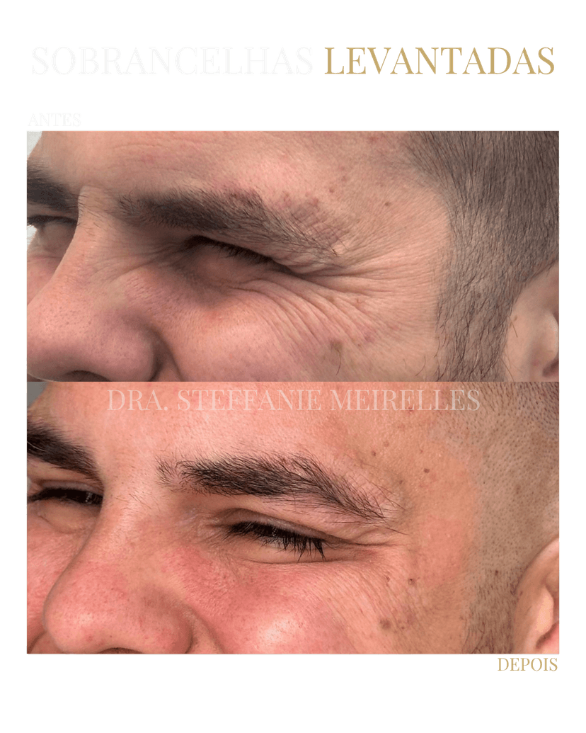 Procedimento de toxina botulínica na clínica