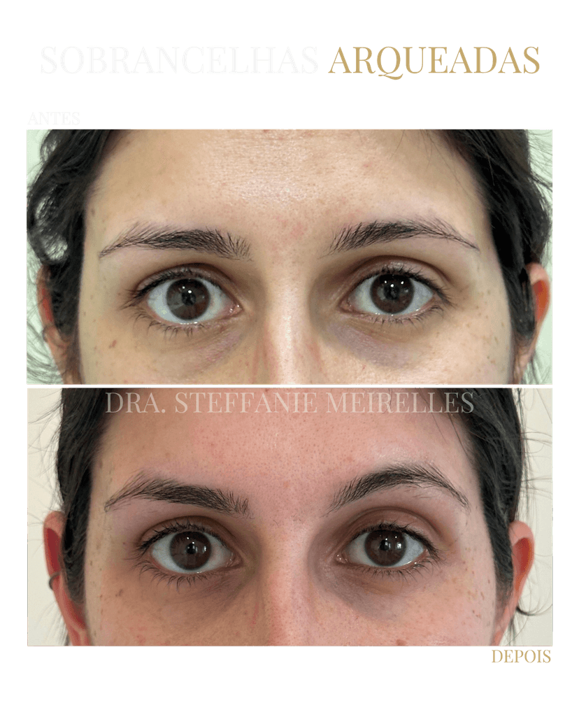 Resultados naturais de Botox na testa