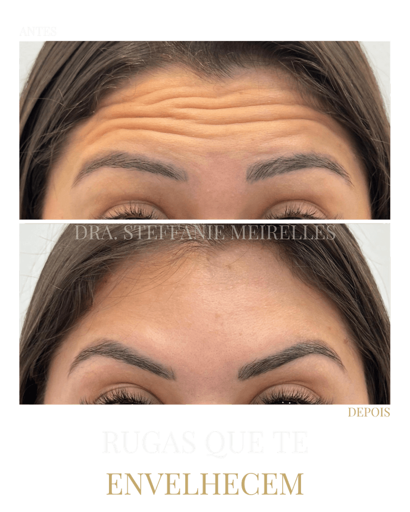 Sorriso gengival tratado com Botox