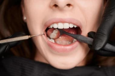 O que é desvitalizar o dente? Quando é necessário?